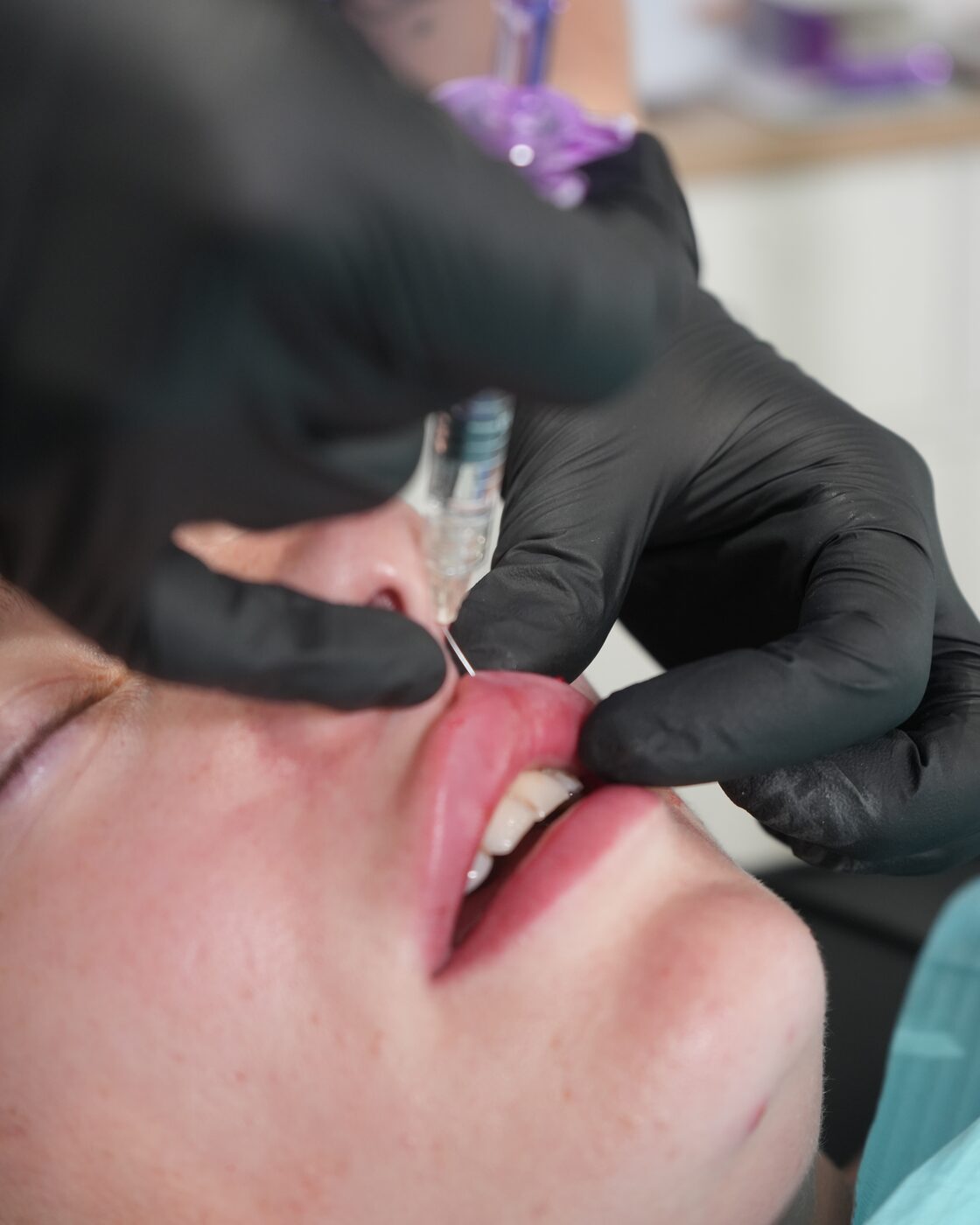 Lip filler being placed by Becci, NMC registered nurse, at The Face Lab